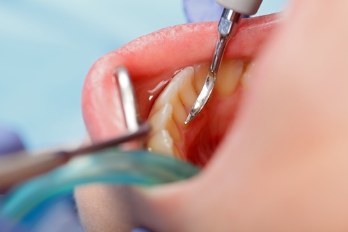 Dental calculus removing