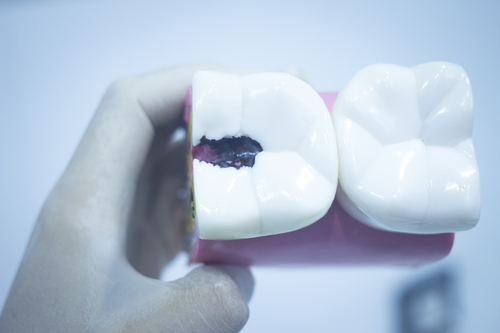 Dental tooth model cast showing decay enamel roots