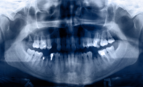 Panoramic dental X-Ray