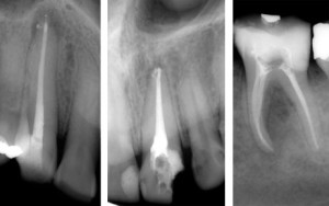 endodoncie